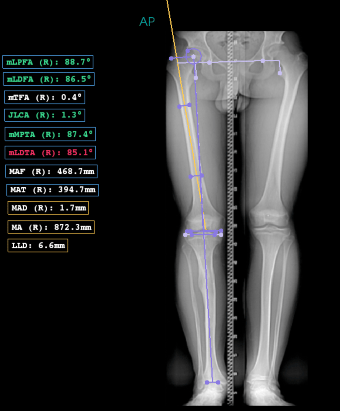 Measuring Tibia Length Pediatrics | Limb Deformity Analysis: How to perform