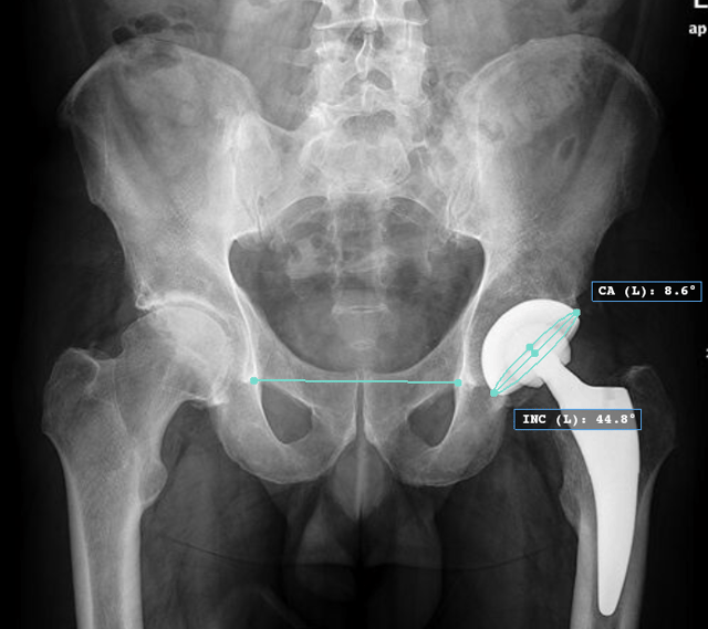 Acetabular Cup Position How to perform