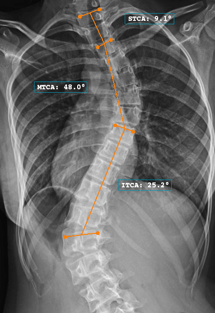 tca_1