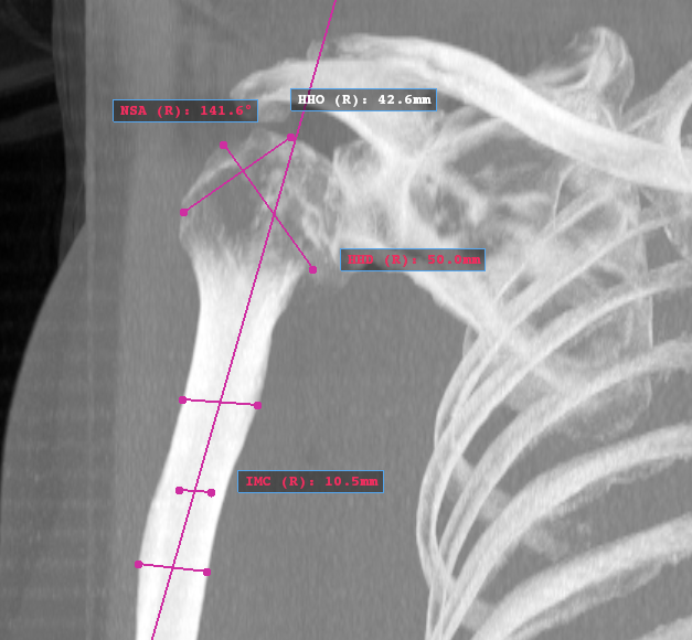 Total shoulder replacement How to perform